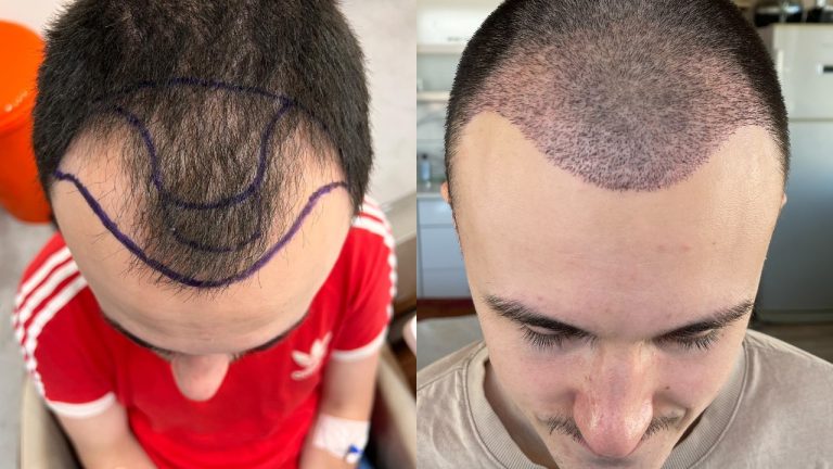 Key Benefit of Hair Transplant: Permanent Hair Growth