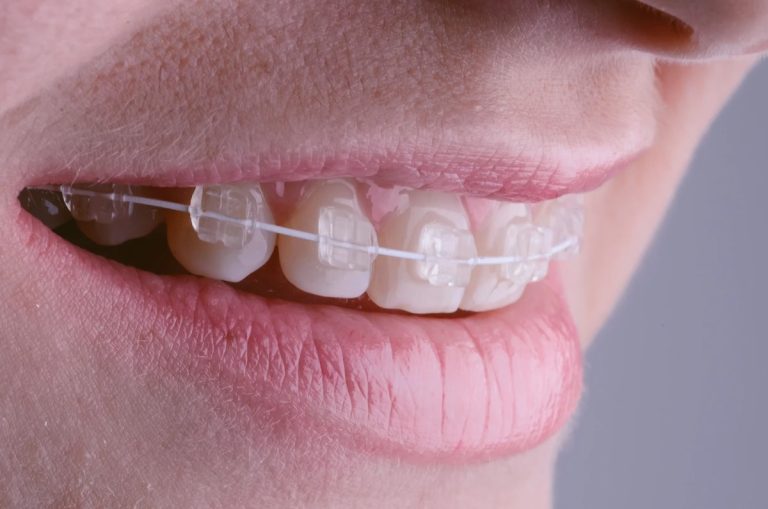 Braces Myrtle Beach: What to Expect Month by Month